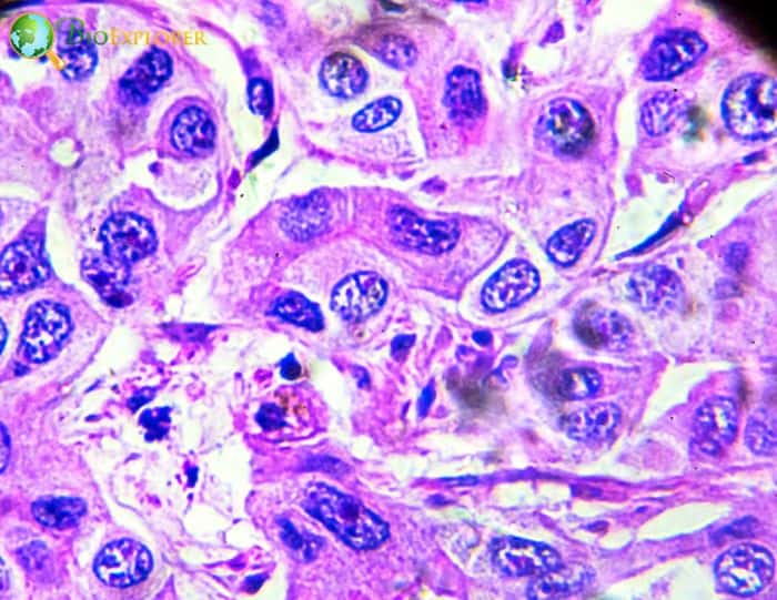 Hepatocellular Carcinoma