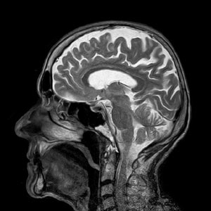 MRI Scan Human Head