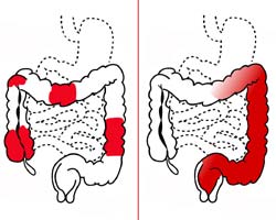 Colitis