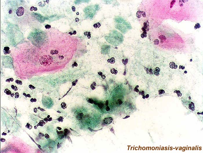 Trichomoniasis vaginalis