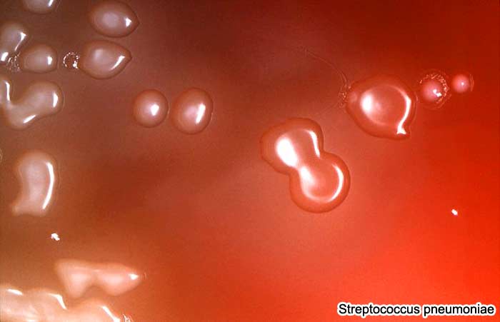 Streptococcus pneumoniae causes Meningitis