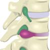 Spinal Disc