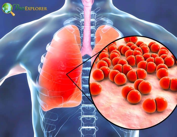 COVID and Pneumonia Differences