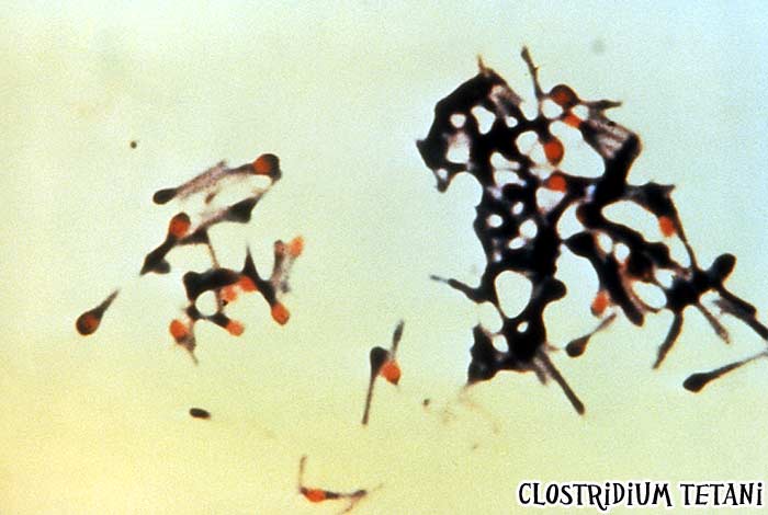 Clostridium tetani causes Tetanus