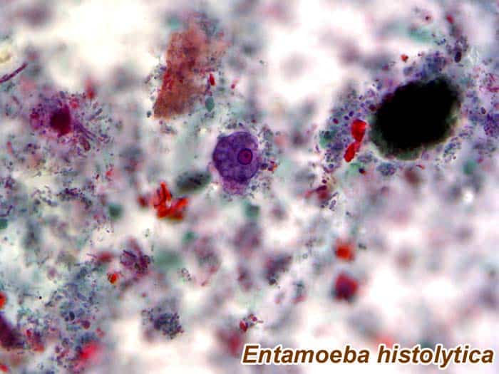 Entamoeba histolytica