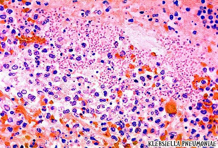 Klebsiella pneumoniae causes Pneumonia