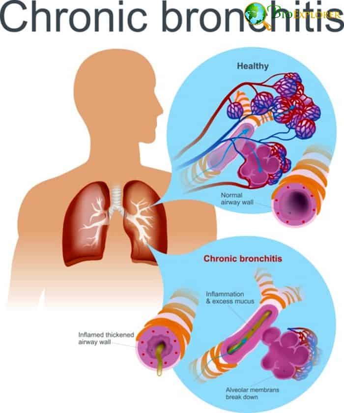 Plastic Bronchitis