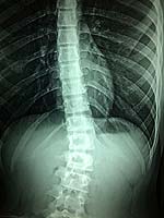 spinal injury