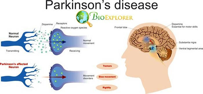 Parkinsons Disease