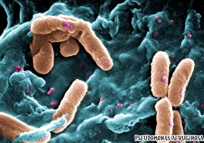 Pseudomona aeruginosa causes Pseudomonas Infection