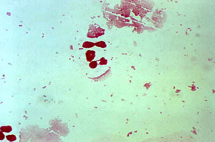 Gonorrhea Neisseria (Pleomorphic)