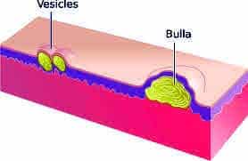 Vesicle